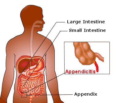 Appendix Pain In Children