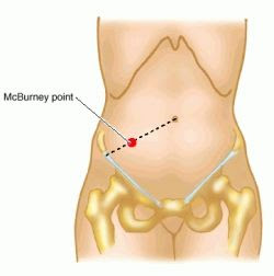 Appendix Pain Location