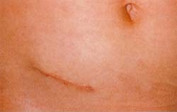 Appendix Removal Scar