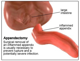 Appendix Removal Surgery