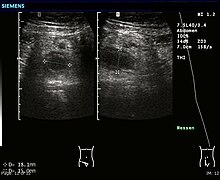 Appendix Removal Surgery Risks