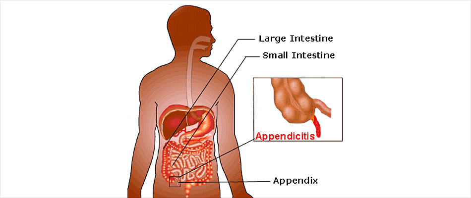 Appendix Removal Symptoms