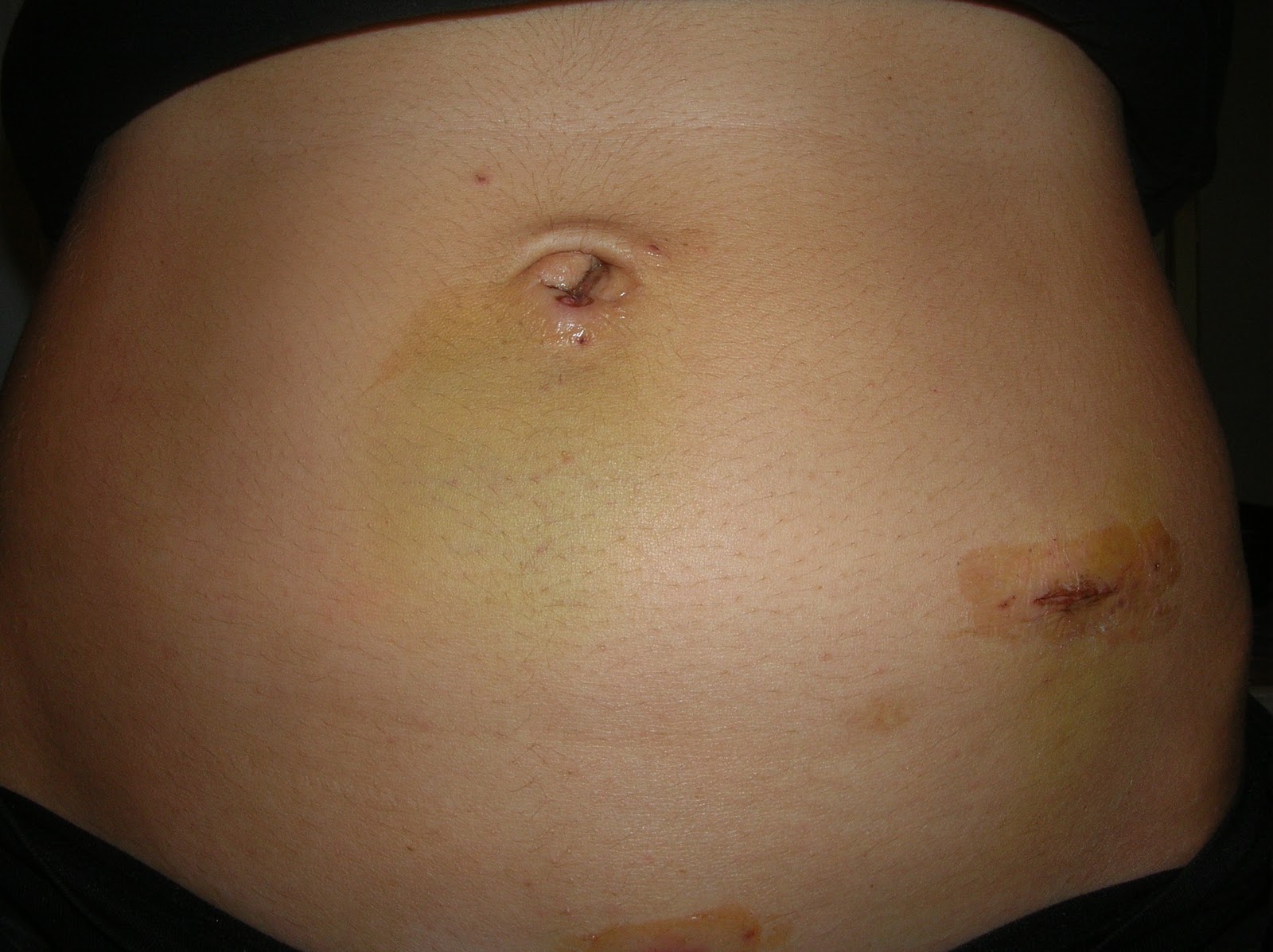 Appendix Scar