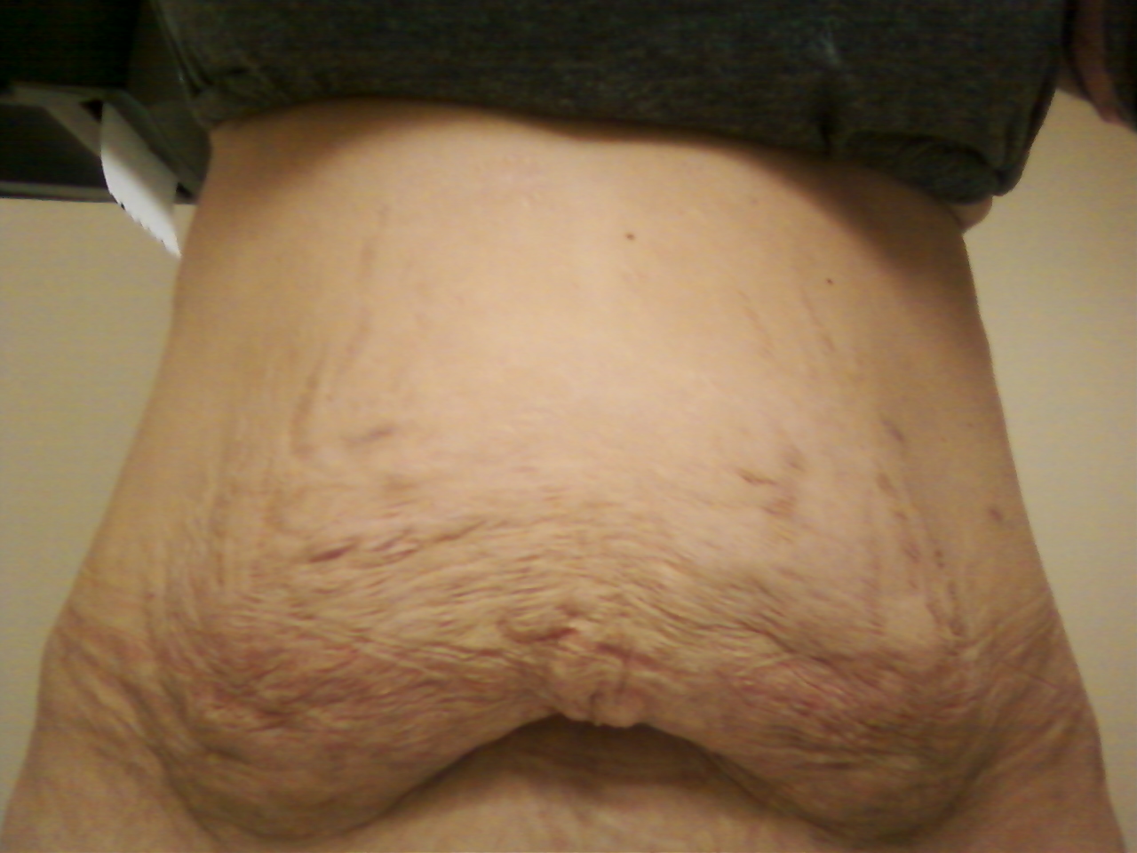 Appendix Scar