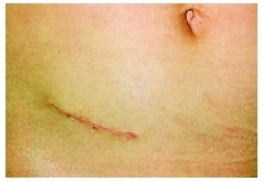 Appendix Scar Removal