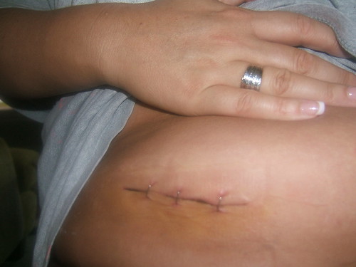 Appendix Scar Removal