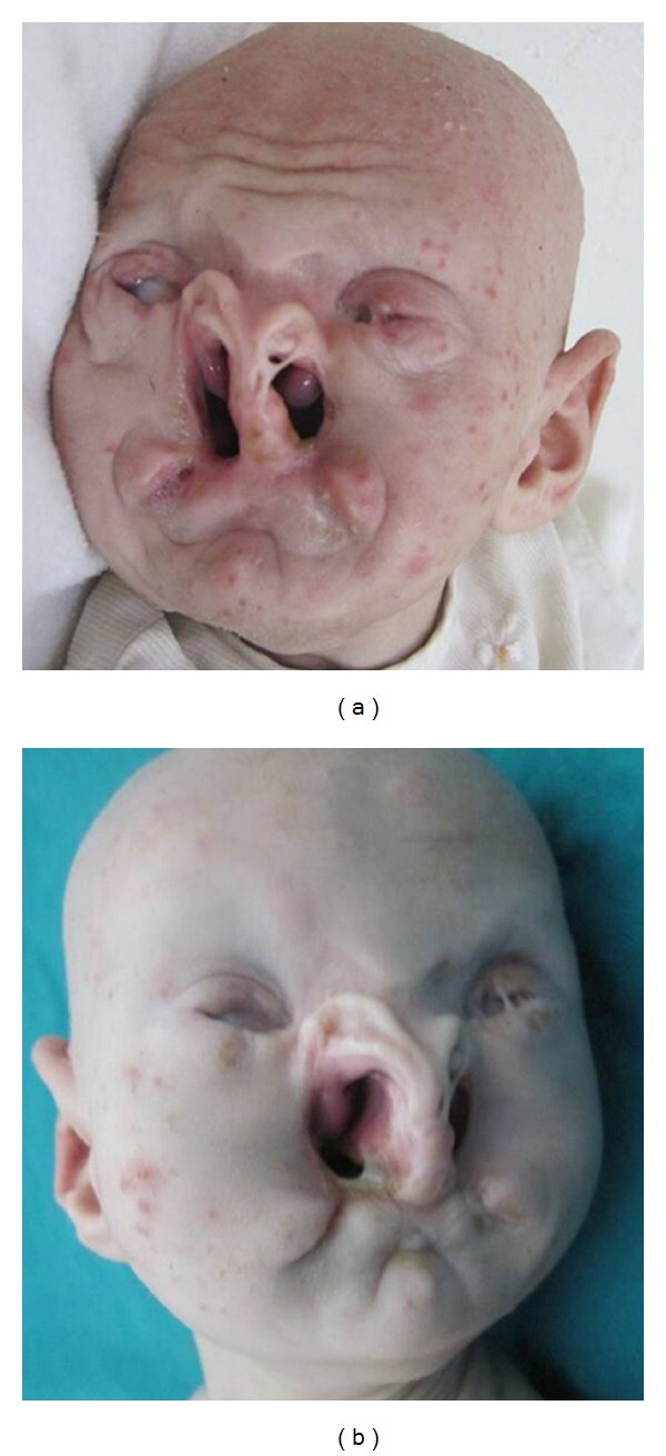 Bartsocas Papas Popliteal Pterygium Syndrome