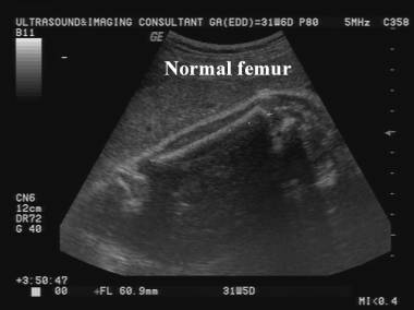 Bartsocas Papas Popliteal Pterygium Syndrome