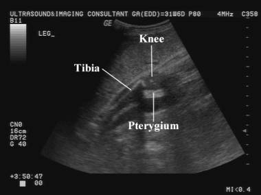 Bartsocas Papas Popliteal Pterygium Syndrome