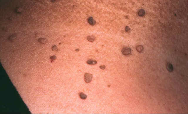 Cancerous Skin Tags On Neck