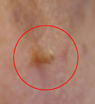 Cancerous Skin Tags On Neck