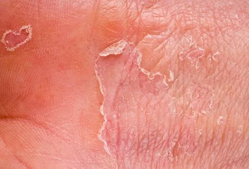 Common Skin Rashes In Adults