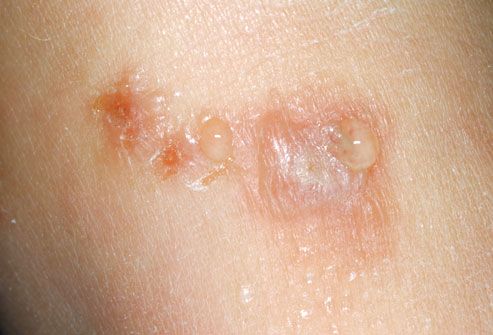 Common Skin Rashes In Adults