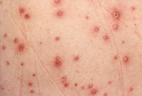 Common Skin Rashes In Adults