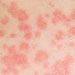 Common Skin Rashes In Adults Face