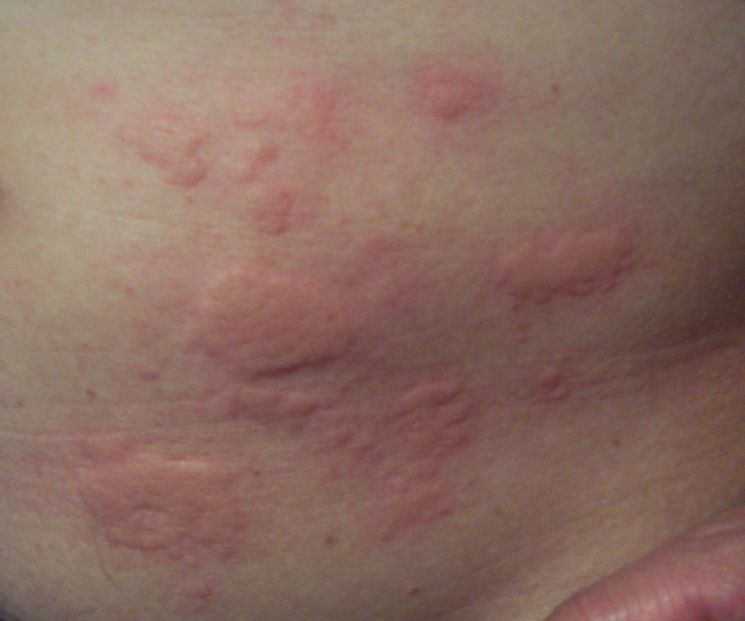 Common Skin Rashes In Adults Face