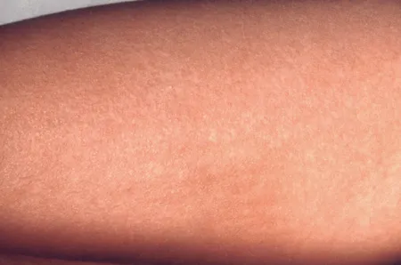 Common Skin Rashes On Arms