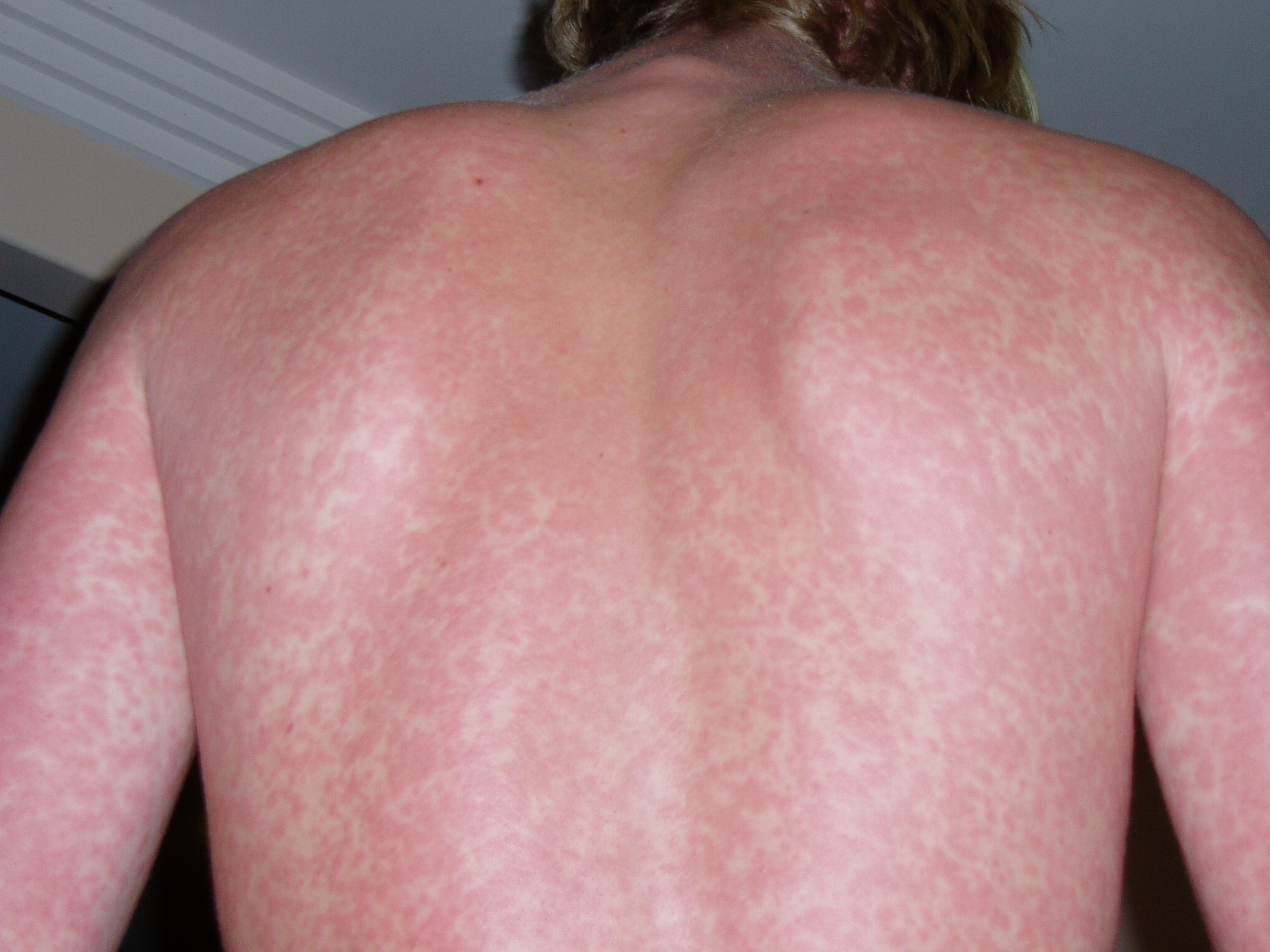 Common Skin Rashes On Arms