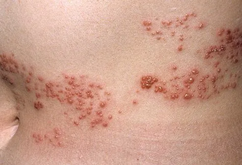 Common Skin Rashes On Arms