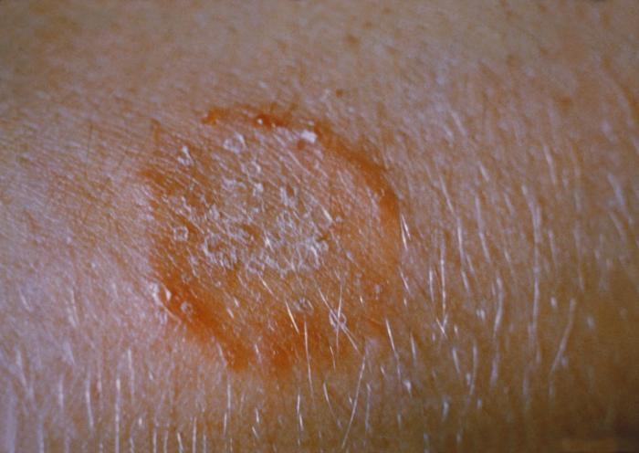 Common Skin Rashes On Arms