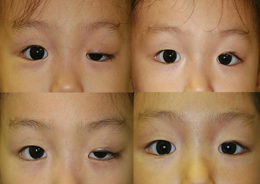 Congenital Ptosis Surgery Before And After