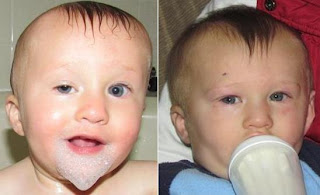 Congenital Ptosis Surgery Before And After