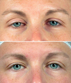 Congenital Ptosis Surgery Before And After