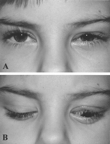 Congenital Ptosis Surgery Before And After