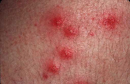 Contact Dermatitis Blisters