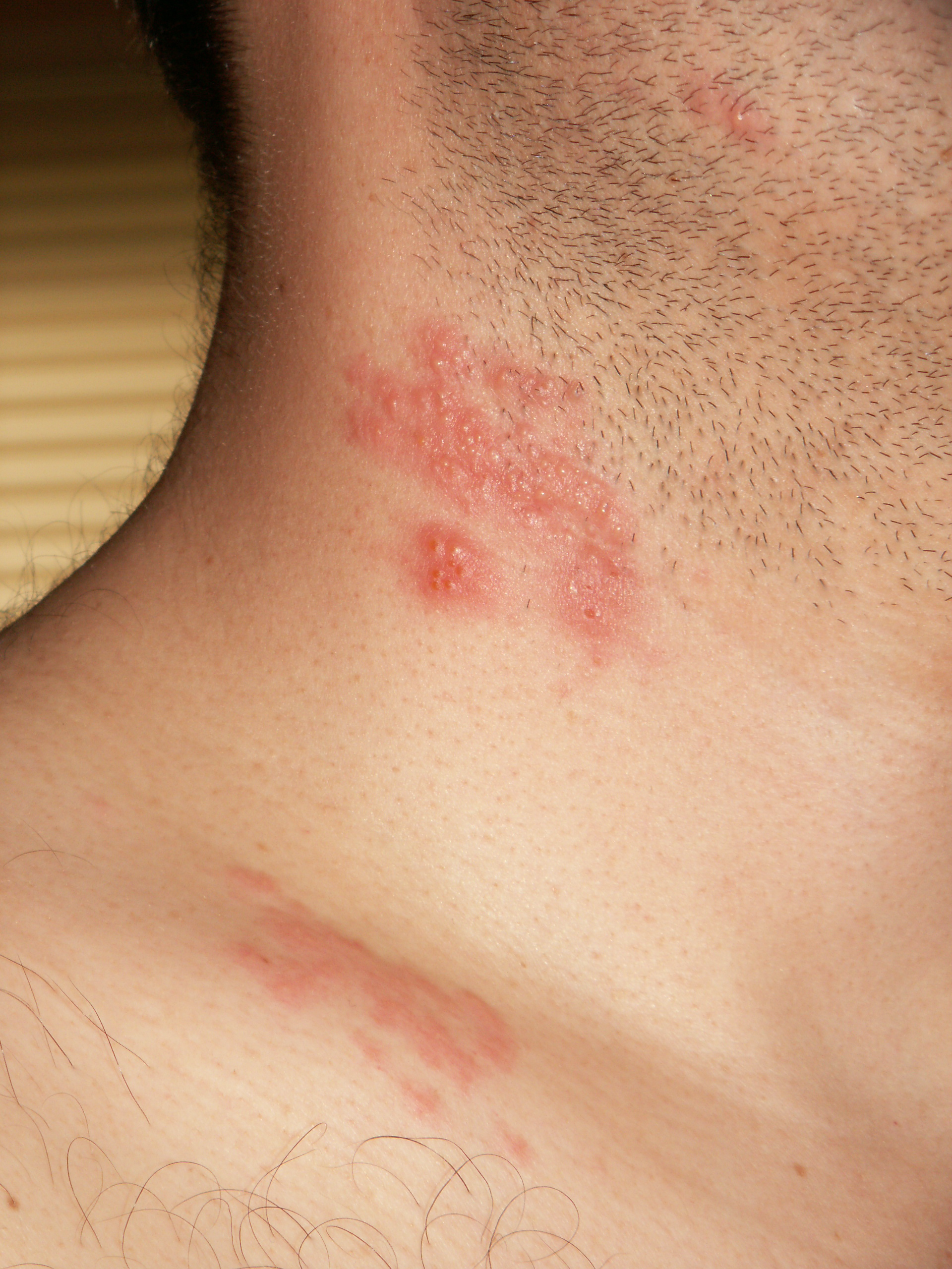 Contact Dermatitis Blisters