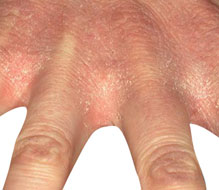 Contact Dermatitis Blisters