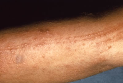 Contact Dermatitis Blisters Pictures