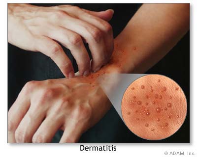 Contact Dermatitis Blisters Pictures