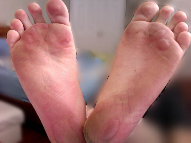 Contact Dermatitis Blisters Pictures