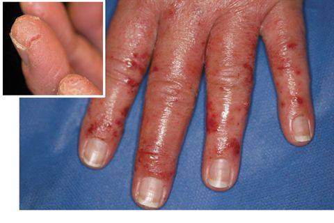 Contact Dermatitis Blisters Pictures