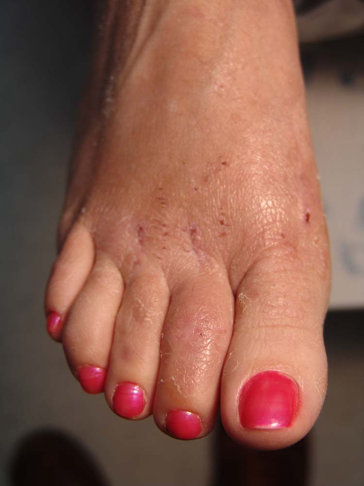 Contact Dermatitis Blisters Pictures