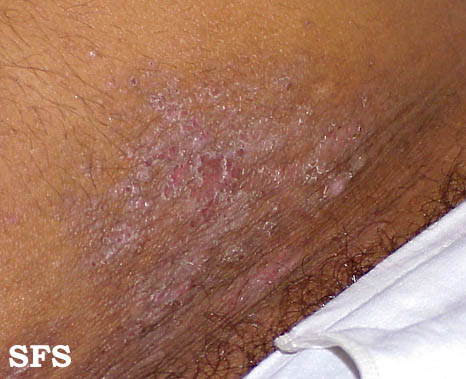 Contact Dermatitis Causes