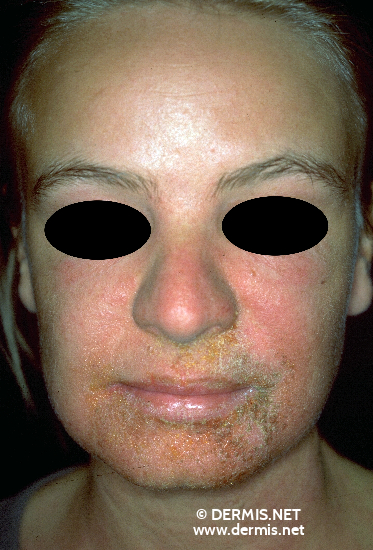 Contact Dermatitis Face Images