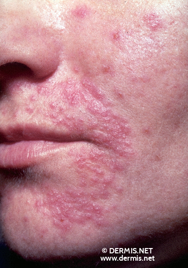 Contact Dermatitis Face Images