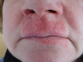 Contact Dermatitis Lips