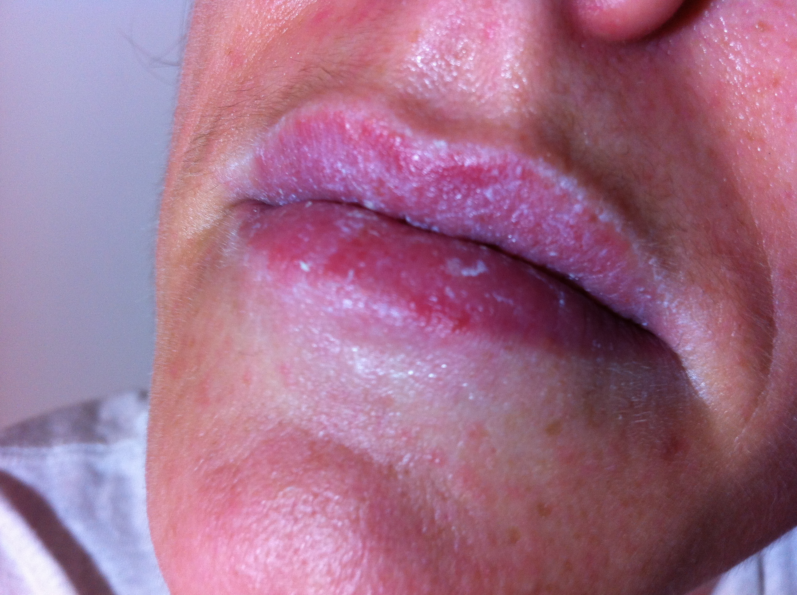 Contact Dermatitis Lips