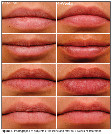 Contact Dermatitis Lips Pictures