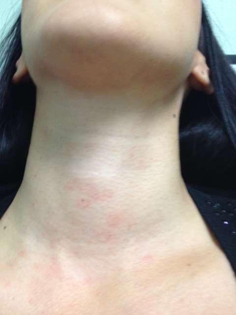 Contact Dermatitis Neck