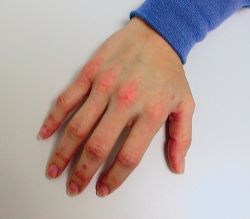 Contact Dermatitis On Hands