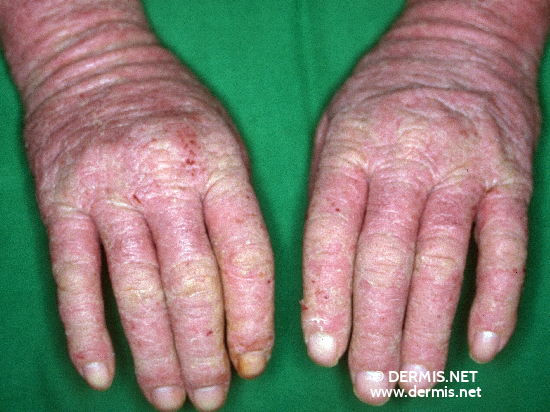 Contact Dermatitis On Hands