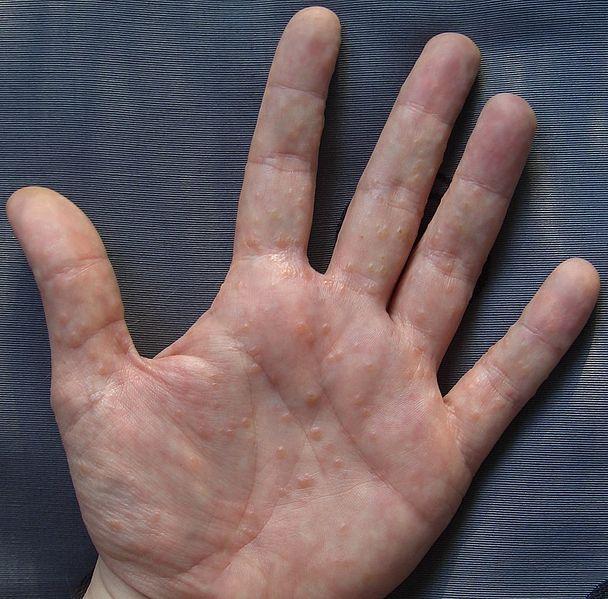 Contact Dermatitis On Hands