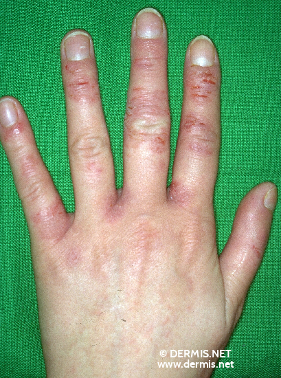 Contact Dermatitis On Hands