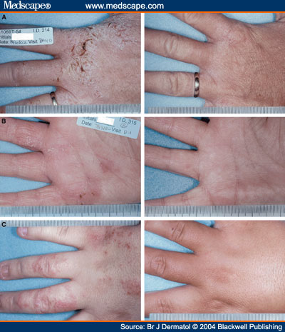 Contact Dermatitis On Hands