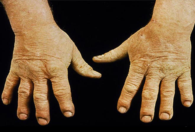 Contact Dermatitis On Hands