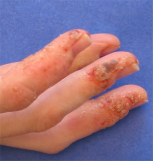 Contact Dermatitis On Hands